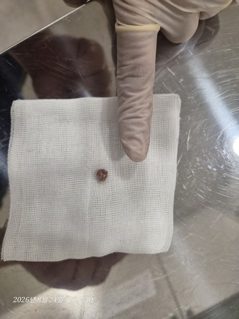 목 뒤 피지낭종 제거 증례의 제거 조직 사진