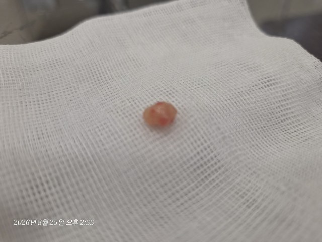 얼굴 부위 양성종양 제거 증례의 제거 조직 사진