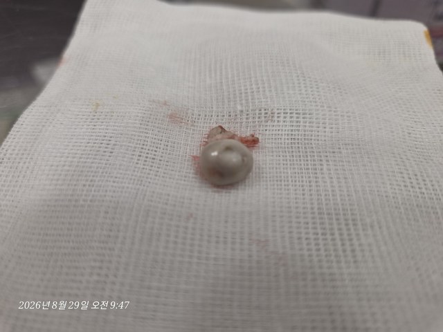어깨 부위 표피낭종 제거 증례의 제거 조직 사진