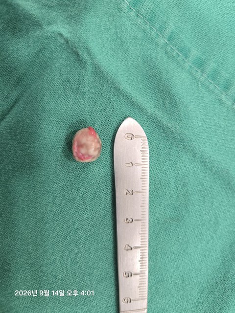 목 중앙부 표피낭종 제거 증례의 제거 조직 사진