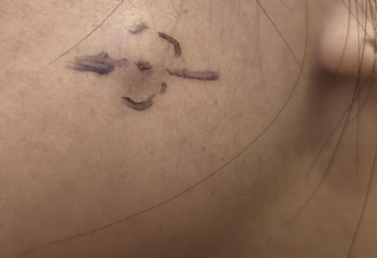 좌측 볼 수술 전 위치 확인 사진 1