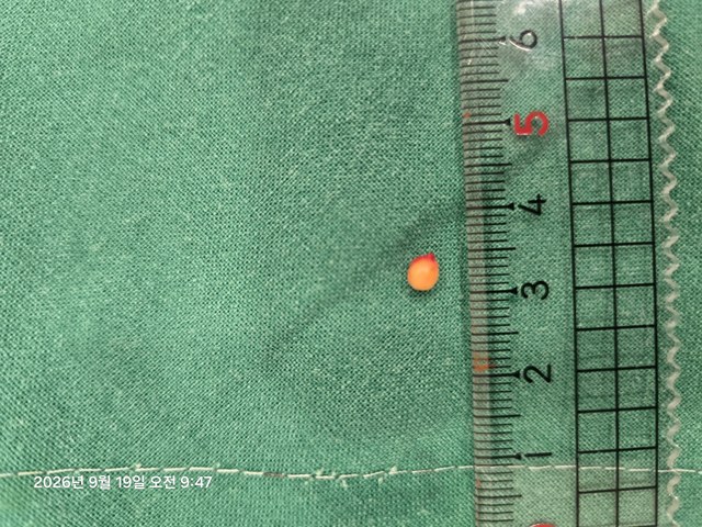 겨드랑이 피지낭종 제거 증례의 제거 조직 사진
