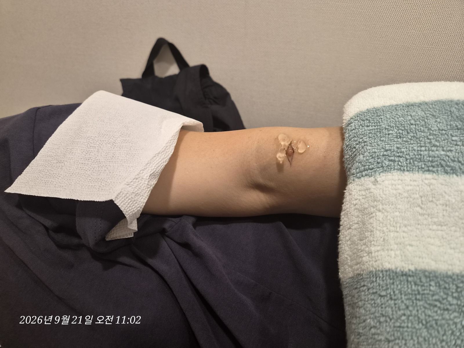 좌측 팔 수술 전 위치 확인 사진 1