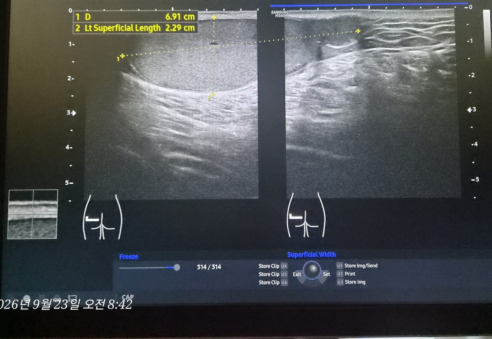 좌측 둔부 초음파 확인 사진 1