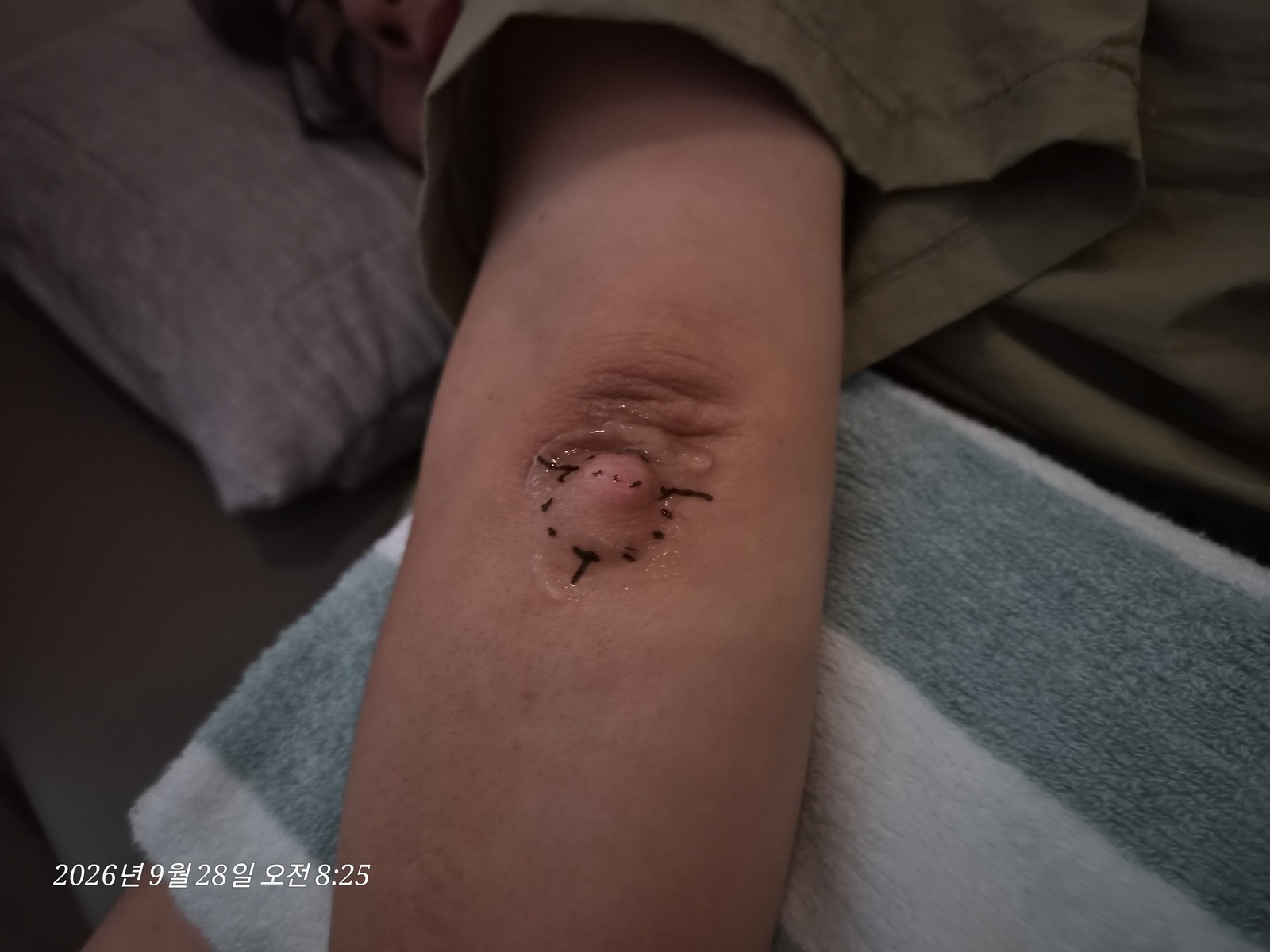팔 수술 전 위치 확인 사진 1
