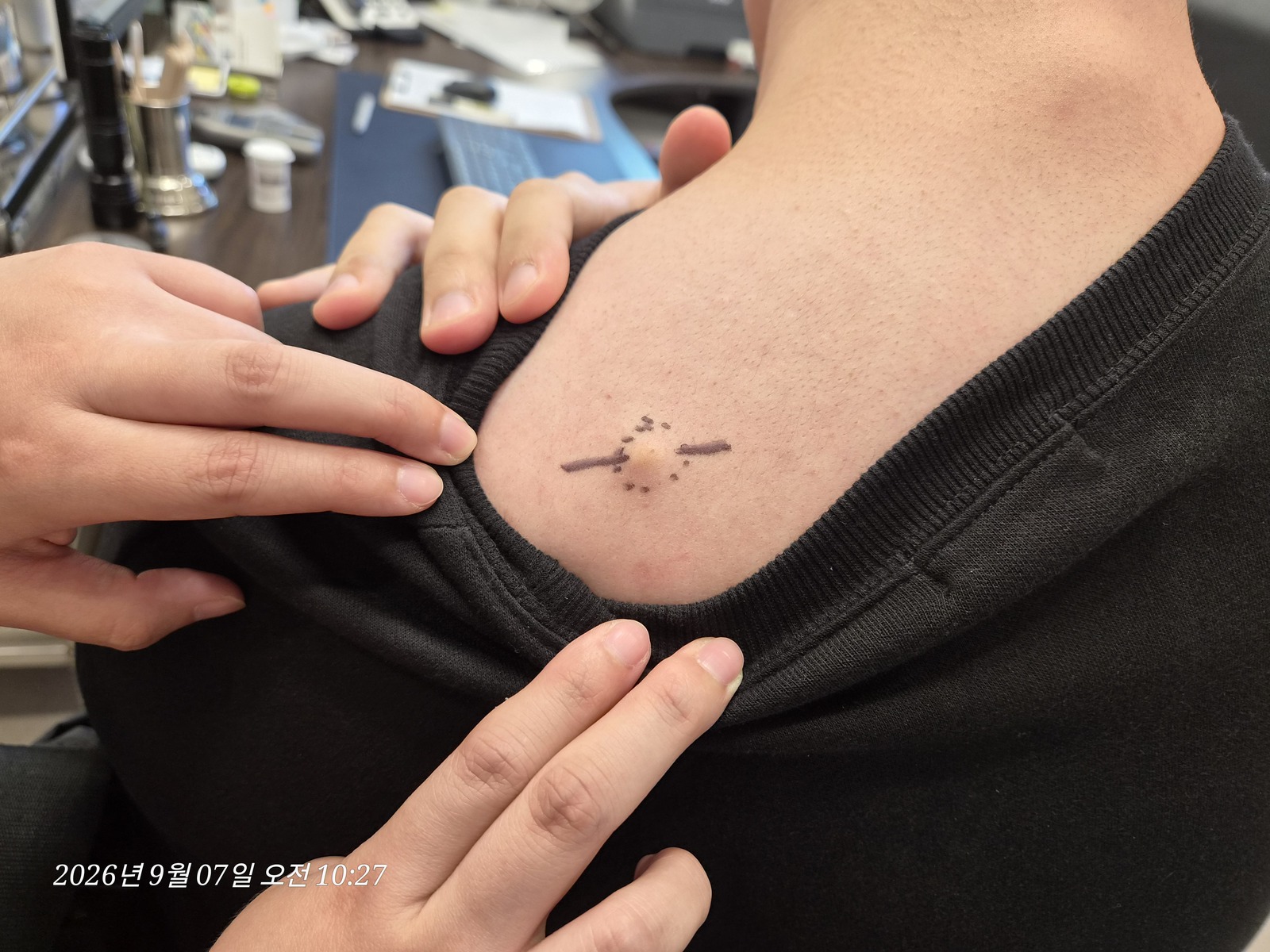 등 수술 전 위치 확인 사진 1