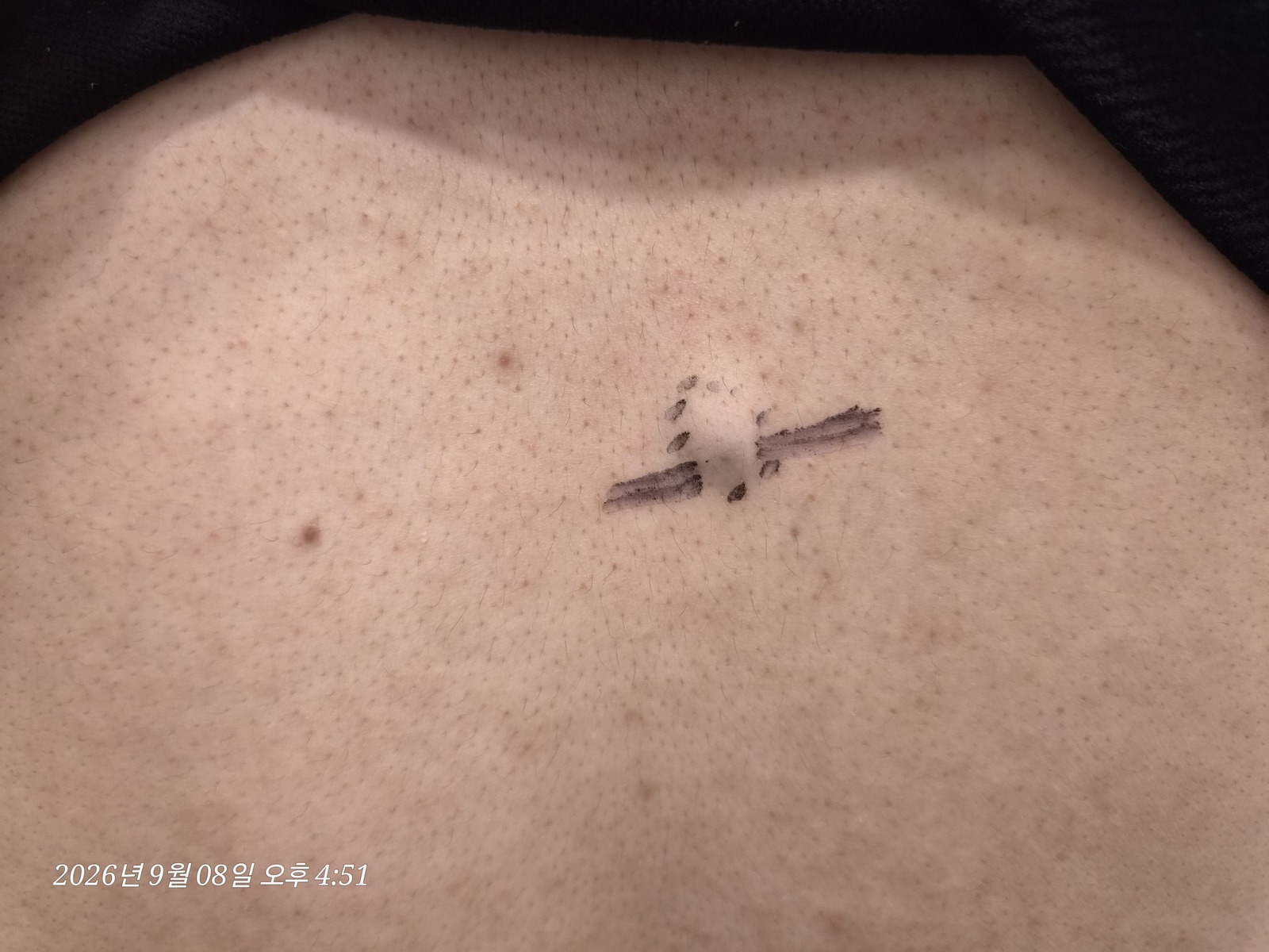 등 수술 전 위치 확인 사진 1